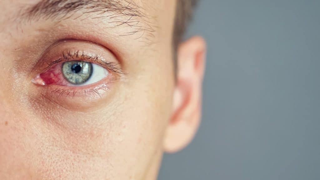 A close-up of a man with a reddened, irritated eye.